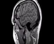 Structural MRI animation from mri aqski tum se serilal xxx fuck